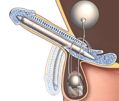penile prosthesis to enlarge it